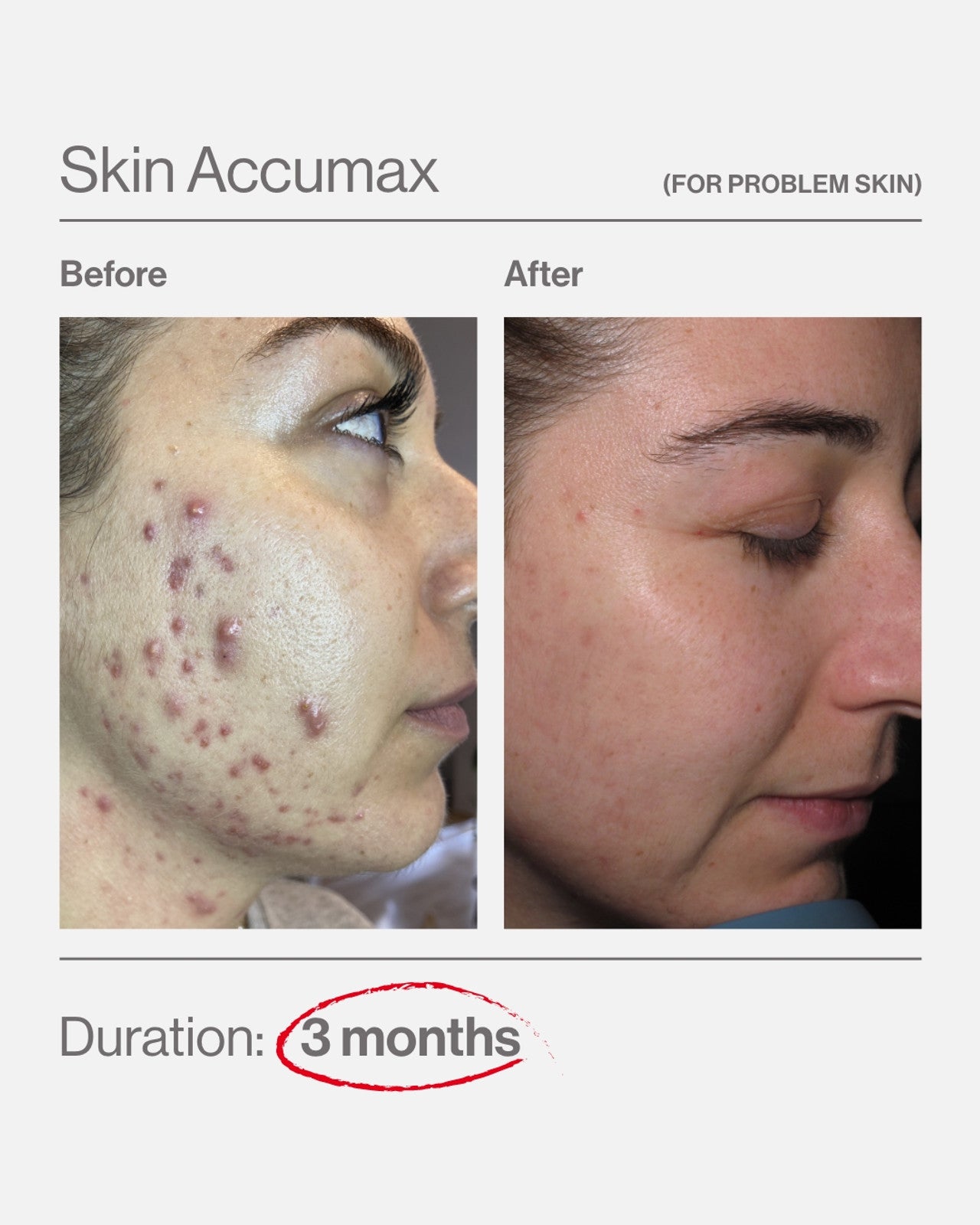Skin Accumax (120 Capsules)